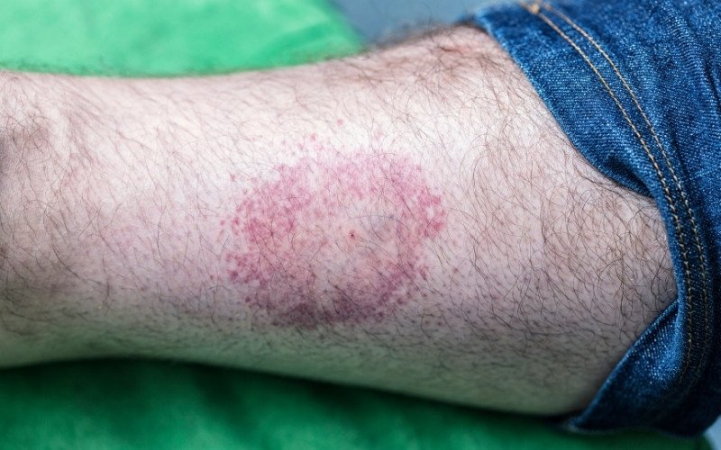 spider bite appearance with surrounding rash